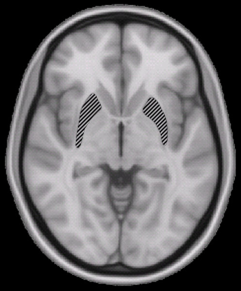 amnesia and neurologic problems are some of the statin side effects