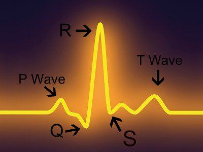 a prolonged qt interval can be measured easily